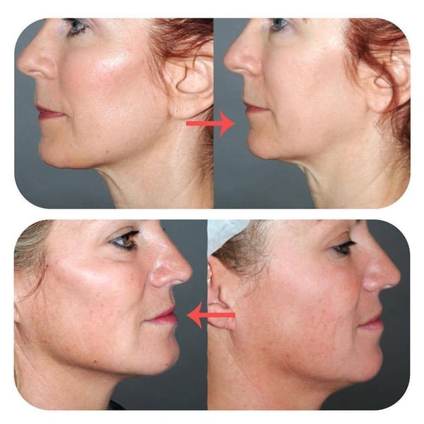 Hirundo Face Lifting Patch Invisible Artifact Sticker