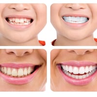 Magic Smile Tannskinne