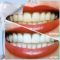 Teeth Whitening Stain Eraser