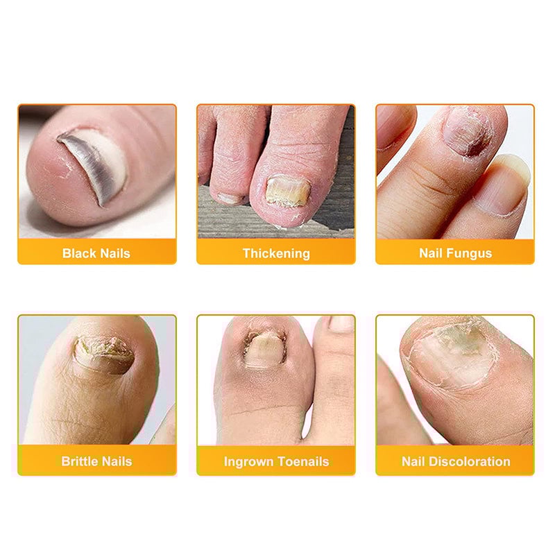 Fungal Nail Patches