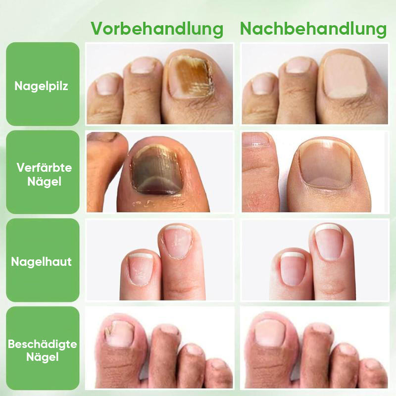 Ingwer-Nagelbehandlung