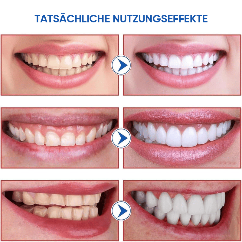 SP-8/SP-10 Probiotische Whitening-Zahnpasta für die Mundgesundheit