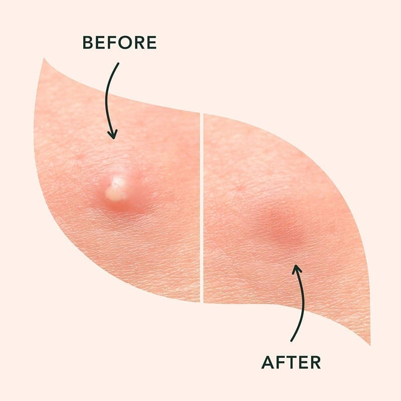 Invisible Acne Patches