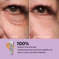 Temporärer Augenstraffer