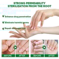 Ginger Nail Treatment