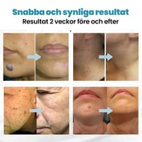 Icke-invasiv laserpenna för borttagning av vårtor och födelsemärken