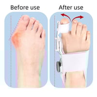 Upgraded Bunion Corrector