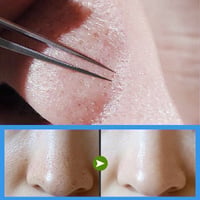 🤏Acne Needle Set - 15PCS✨