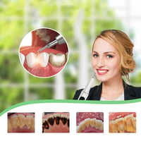 Ultrasone Tandartsreiniger