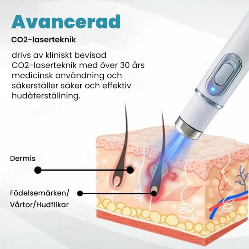 Icke-invasiv laserpenna för borttagning av vårtor och födelsemärken