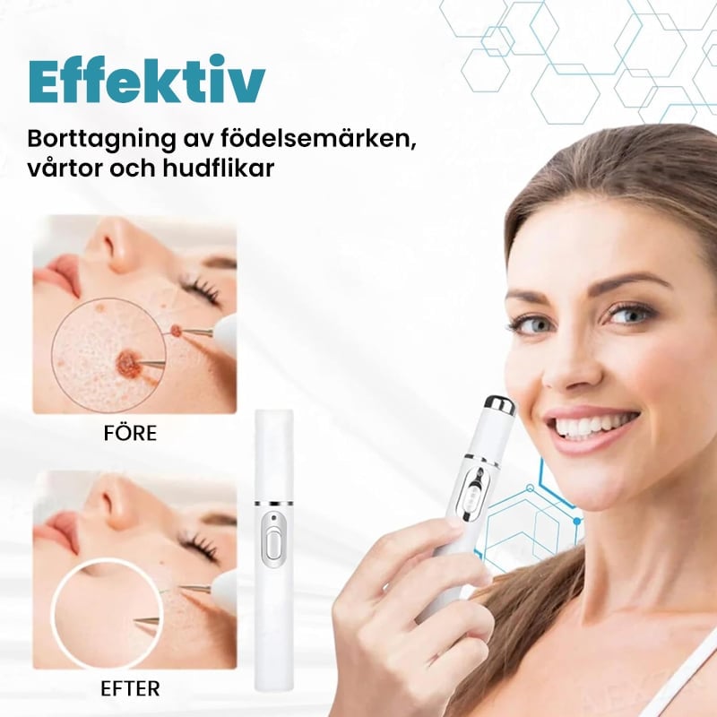 Icke-invasiv laserpenna för borttagning av vårtor och födelsemärken