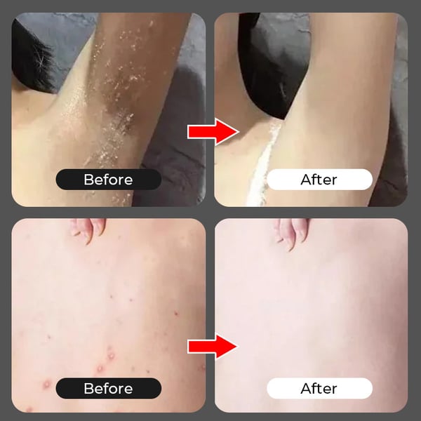 Lichaam Exfoliërende Nicotinamide-gel