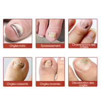 Plaques fongiques sur les ongles