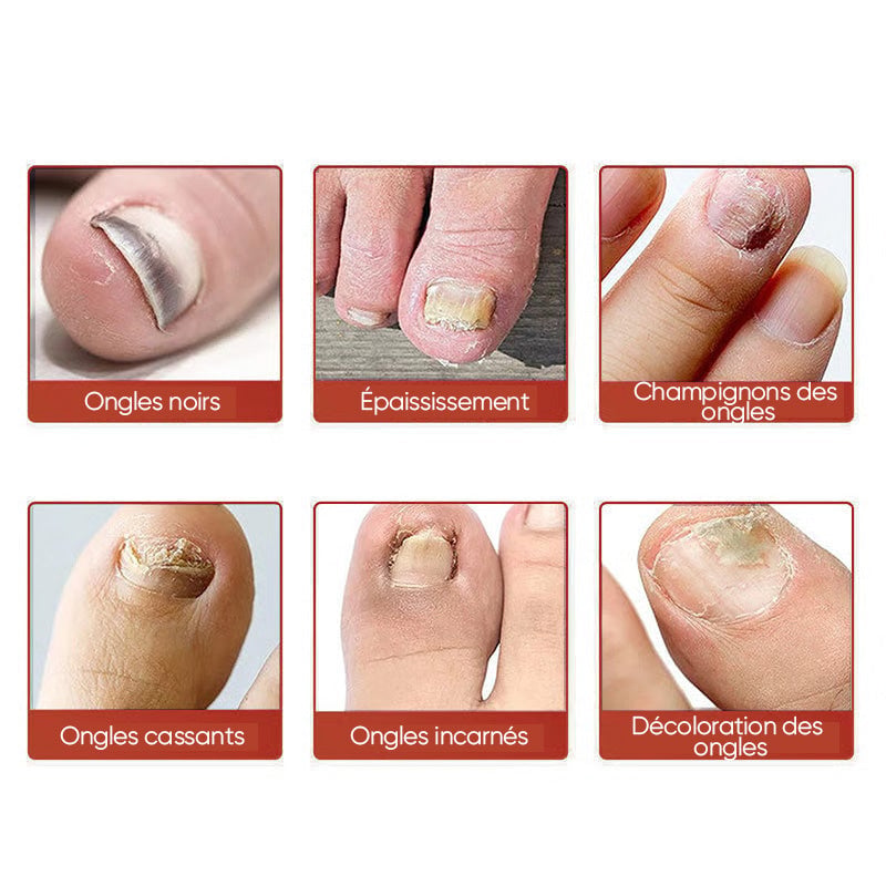 Plaques fongiques sur les ongles
