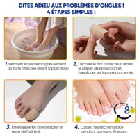 Plaques fongiques sur les ongles