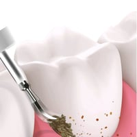 Ultrasone Tandartsreiniger