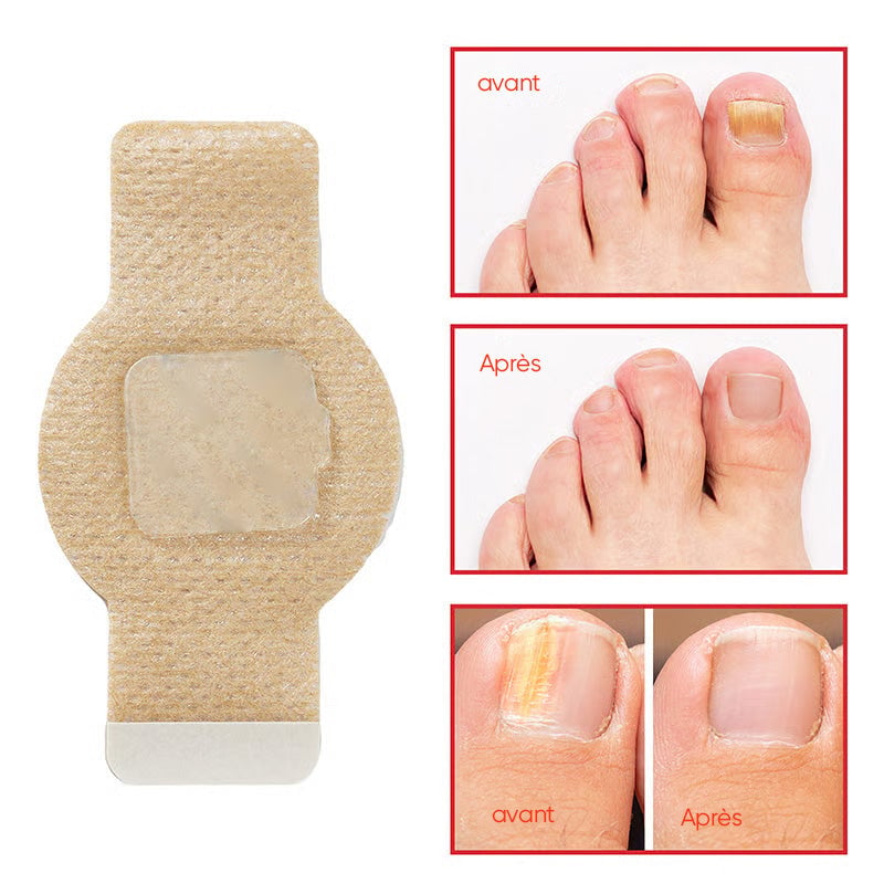 Plaques fongiques sur les ongles