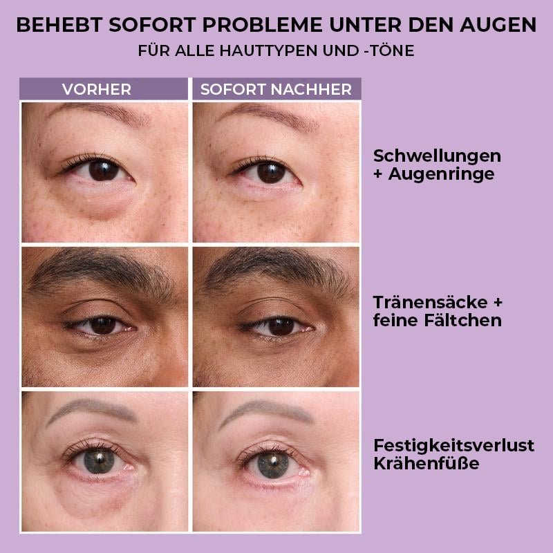 Temporärer Augenstraffer