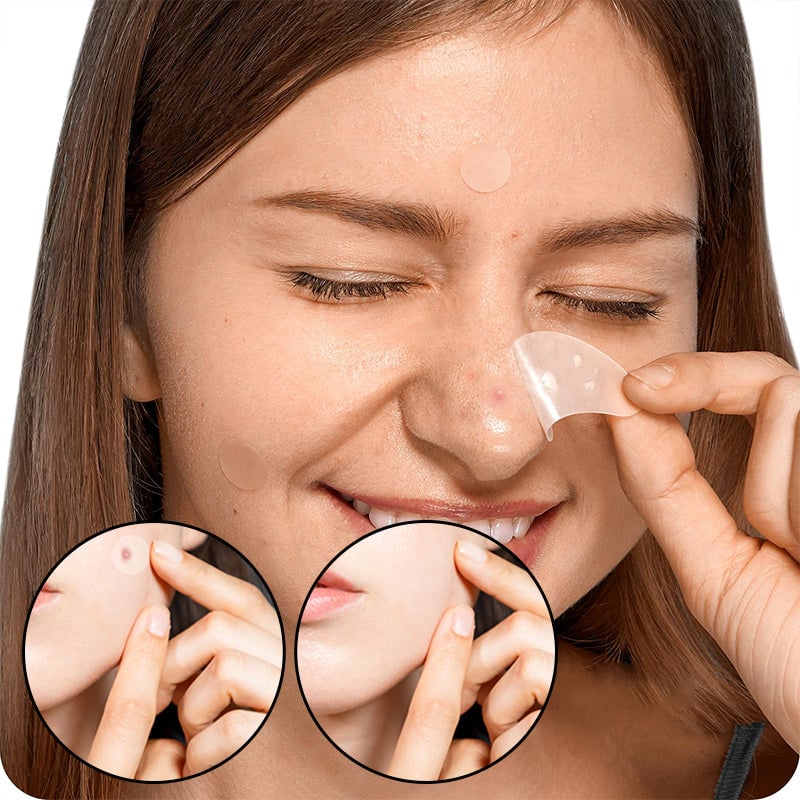 💕Acne Patches💕