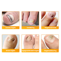 Sale - Schimmelnagelplekken