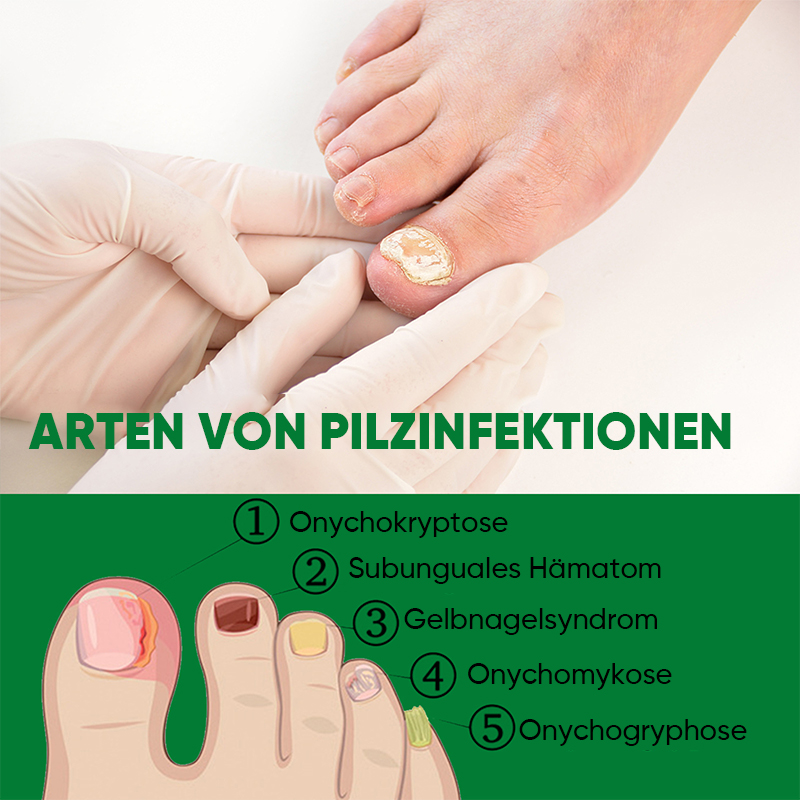 Ingwer-Nagelbehandlung