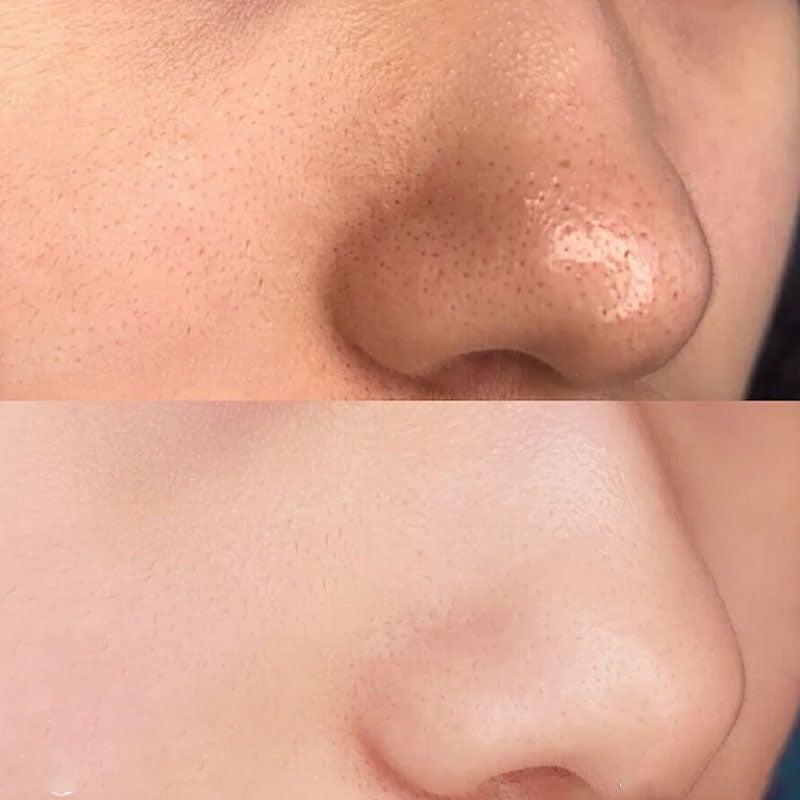 Deep-Cleansing Blackhead Nose Strips